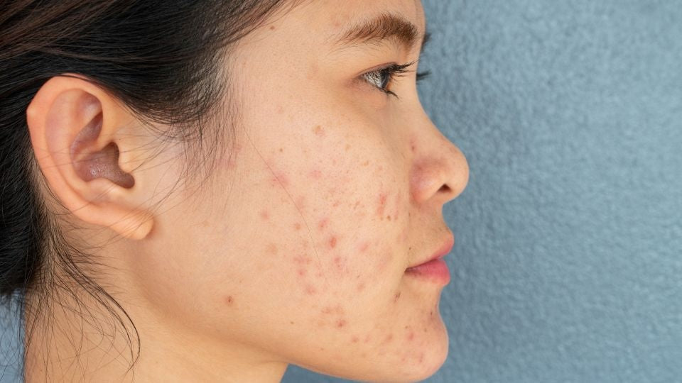 Why Hormonal Skin Issues Aren't Just Hormonal: A Functional Beauty Breakdown of Gut, Liver & Lymph Involvement