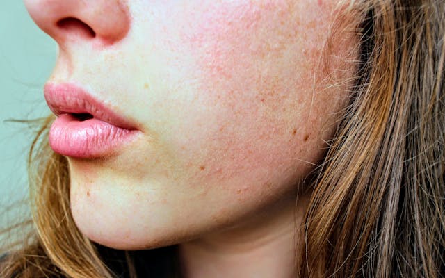 How to Know If Your Skin Barrier Is Damaged (And What to Do About It)